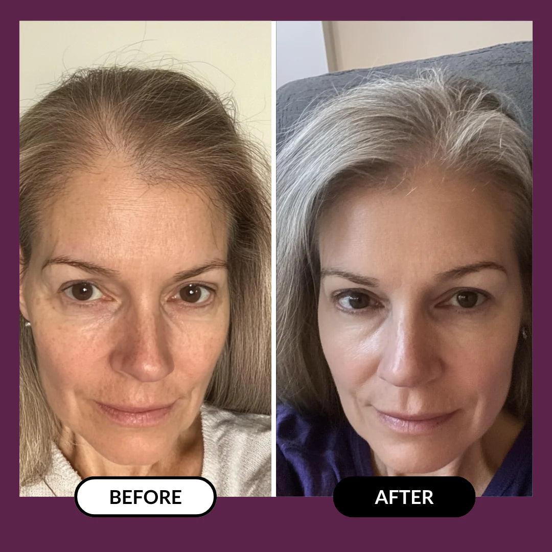 ThickHair - Hair Regrowth System