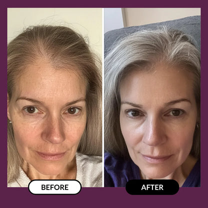 ThickHair - Hair Regrowth System 