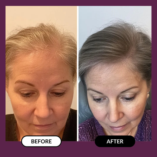 ThickHair - Hair Regrowth System
